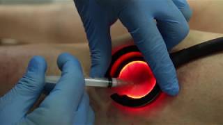 Sclerotherapy using the Veinlite [upl. by Proffitt]