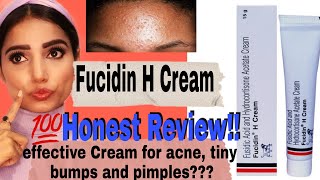 Fucidin H Cream 100 Honest Review amp Uses  Say no to Tiny Bumps  Acne and Pimples  Myra Sharma [upl. by Yemac]