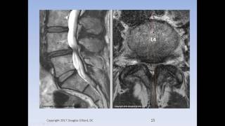 Lumbar Spinal Stenosis Cauda Equina Syndrome Sciatica amp Disc Herniation An Advanced Lecture [upl. by Teirtza]