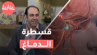 فوائد ومخاطر قسطرة الدماغ عبر شريان الإبهام [upl. by Bearce]