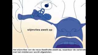 Oorontsteking  Oorzaak en behandeling oorpijn [upl. by Ahsinel]