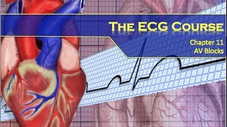 The ECG Course  AV Blocks [upl. by Yrahcaz514]