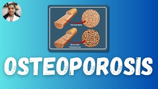 Osteoporosis  Bimithas Nursing Guide osteoporosis psckerala [upl. by Haskel]