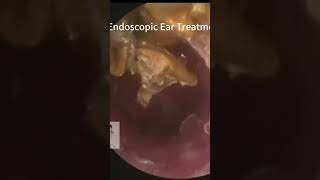 What is Cerumen earwax hearingdoctor eardoctor [upl. by Nyladnarb]