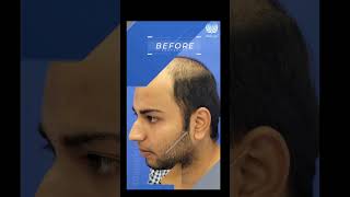 MedLinks Hair Transplant Results  Before After Results shortsfeed shorts medlinks [upl. by Giuseppe417]