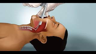 Pediatric Endotracheal Intubation by J Nagler et al  OPENPediatrics [upl. by Er]