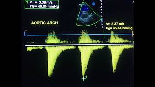 A doppler study clue in coarctation of aorta to drahmadmirdamadisiIXrrx4whO5XRtBV [upl. by Hyacinthe]