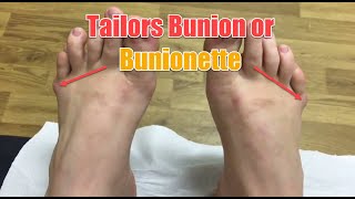 Tailors Bunion or Bunionette  what causes this and how it is treated [upl. by Vish]