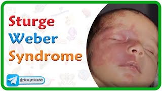 Sturge Weber Syndrome Genetics Clinical manifestations Diagnosis Treatment USMLE Step 1 [upl. by Benzel705]