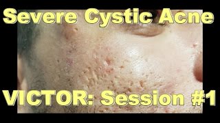 Severe Cystic Acne  Victor Session 1 [upl. by Attelliw]