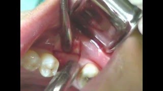 CeraRoot Zirconia Dental Implant Surgery lower molar [upl. by King]