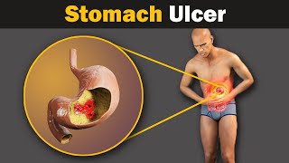 What causes a stomach ulcer Animation [upl. by Ylam]