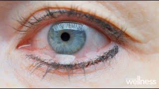 What is evaporative dry eye and how to treat it [upl. by Akenehs305]