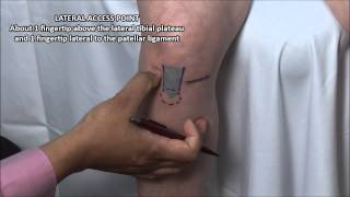 Knee Injection  Anterior Approach [upl. by Ynoffit]