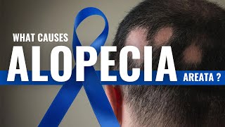 What Causes Alopecia Areata Explained By DrAsif [upl. by Ellicec]