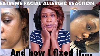 EXTREME FACIAL ALLERGIC REACTION AND HOW I FIXED IT  STORYTIME [upl. by Mickelson]