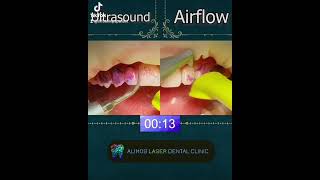 Teeth cleaning Ultrasound vs Airflow Biofilm removal [upl. by Attekal]