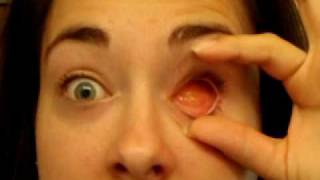 June 08 Removing and Replacing my prosthetic eye [upl. by Ssew]