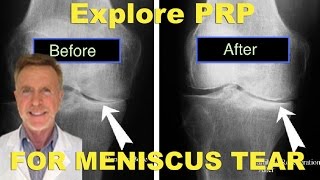 PRP to the Medial Meniscus for repair without surgery Sarasota Florida PRP Doctor [upl. by Arretak]