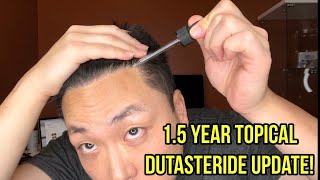 TOPICAL DUTASTERIDE UPDATE AFTER 15 YEARS [upl. by Harli]