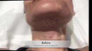 Belkyra  Eliminación de papada sin cirugía  Dermaforyou [upl. by Calderon56]