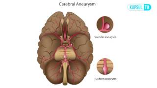 Beyin Anevrizması Nedir Neden Olur [upl. by Kcirad154]