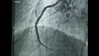 PRIMARY ANGIOPLASTY IN ACUTE MYOCARDIAL INFARCTION [upl. by Geminius]