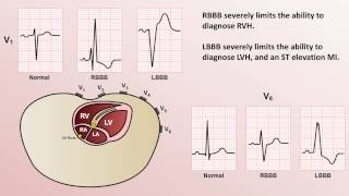 Intro to EKG Interpretation  Bundle Branch Blocks [upl. by Gusti]