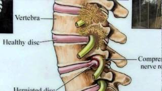 8  Entrapment in Spine [upl. by Llennehc]