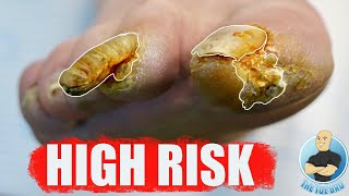 EXTREMELY HIGH RISK NAIL CUTTING OF SUPER THICK TOENAIL [upl. by Adnof]