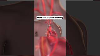 Mechanical Thrombectomy￼ [upl. by Spillihp624]