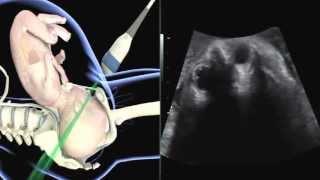 ISUOG how to perform ultrasound in labor assessment of fetal occiput position [upl. by Iinde]