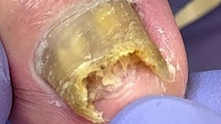 Extremely curly and growing nails infected by onychomycosis bacteria【Doctor Liu Pedicure】 [upl. by Strawn]