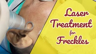 Laser treatment for freckles [upl. by Guyon223]