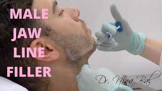 🆕 Male Jawline Fillers Before And After 💕 Dr Nina Bal💕 Jawline Transformation [upl. by Sparkie]