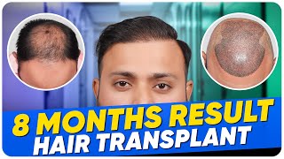 Hair Transplant Results  Best Cost amp Best Hair Transplant Result [upl. by Malinin810]