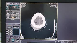 Scalp Heamatoma on CT Brain [upl. by Bashuk]