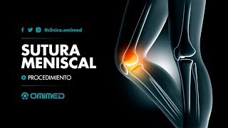 SUTURA MENISCAL [upl. by Haggi918]