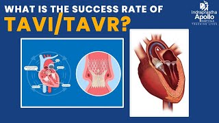 What is the Success Rate of TAVITAVR  Dr Ranjan Modi  Apollo Hospital [upl. by Pollock]