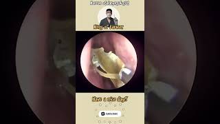 rhinorrhea sinusitis bersihkankuping satisfyingvideos pembersihan telinga video puas hati [upl. by Hsetih]