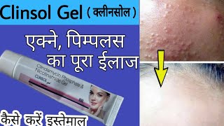 Clinsol Gel Review In Hindi  एक्ने पिम्पलस ऑयली स्किन की असरदार दवा [upl. by Leirrad]