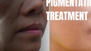 samundri jhagpigmentation treatmentdark spotpigmentation [upl. by Publia]