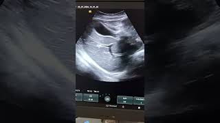 whole abdominal ultrasound [upl. by Dafna35]