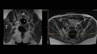 Worried about ovarian cancer What is the pelvic mass [upl. by Ellenahs]