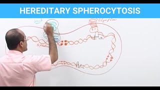 Hereditary Spherocytosis  Diagnosis amp Treatment  Genetics👨‍⚕️ [upl. by Tamqrah]