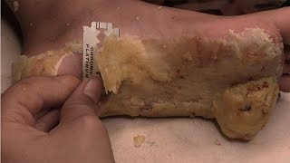 How to removal skin  callus removal skin flakes 07 [upl. by Trinity670]