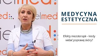 Efekty mezoterapii – kiedy widać poprawę skóry [upl. by Rigby]