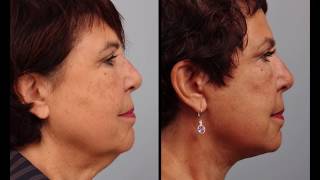 Day by Day Facelift amp Necklift Recovery [upl. by Annazor]