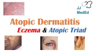 Eczema Atopic Dermatitis  Atopic Triad Triggers Who gets it Why does it happen amp Treatment [upl. by Tuckie421]