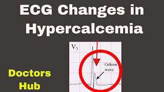 Hypercalcemia ECG Changes [upl. by Eimas56]